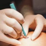 Biópsia de Pele: O Que É e Por Que Você Não Deve Ter Medo