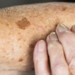 Danos do Sol na Pele: Como o Sol Envelhece e Pode Causar Câncer de Pele 3 Danos do Sol na Pele: Como o Sol Envelhece e Pode Causar Câncer de Pele