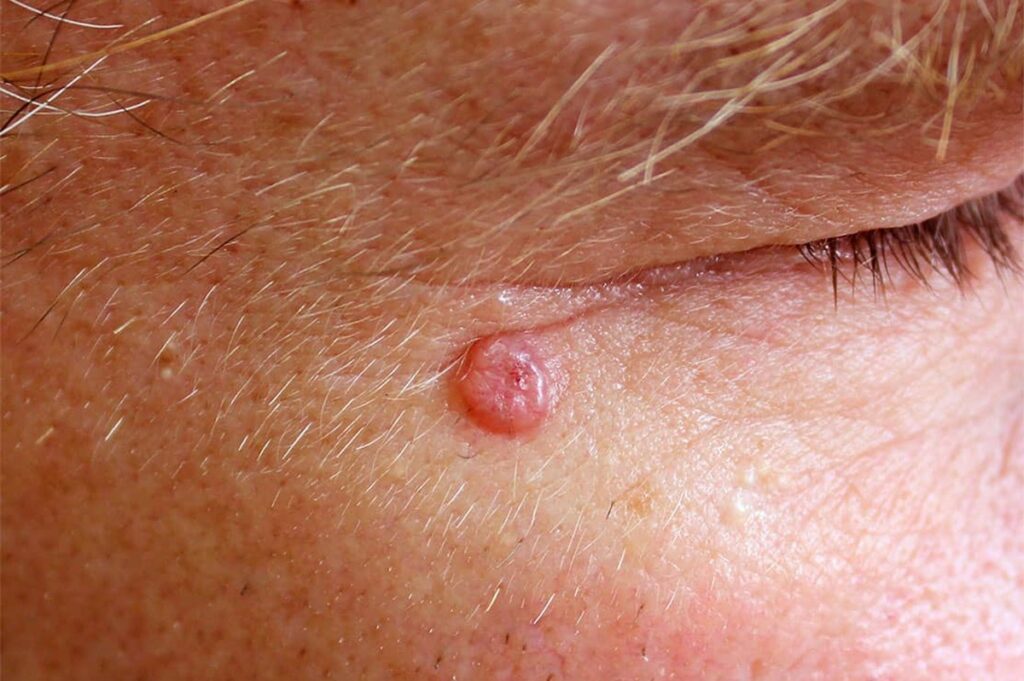 Carcinoma Basocelular: O Câncer de Pele Mais Comum (e que Não Deve Ser Ignorado)