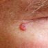 Carcinoma Basocelular: O Câncer de Pele Mais Comum (e que Não Deve Ser Ignorado)