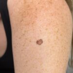Melanoma: Como Identificar os Primeiros Sinais e Garantir o Diagnóstico Precoce 3 Melanoma: Como Identificar os Primeiros Sinais e Garantir o Diagnóstico Precoce
