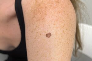 melanoma fer ok