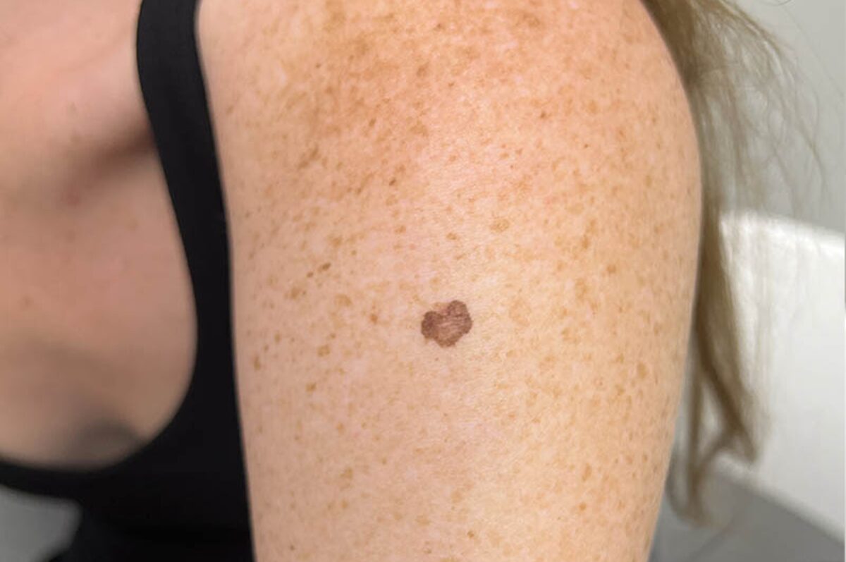 Melanoma: Como Identificar os Primeiros Sinais e Garantir o Diagnóstico Precoce